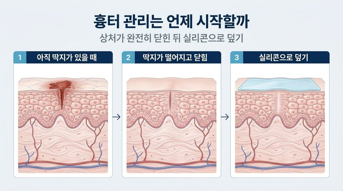 딱지가 남아 있는 상처, 딱지가 떨어지고 표피가 닫힌 상처, 그 위를 실리콘 시트로 덮은 상태를 피부 단면 세 칸으로 보여주는 자료화면